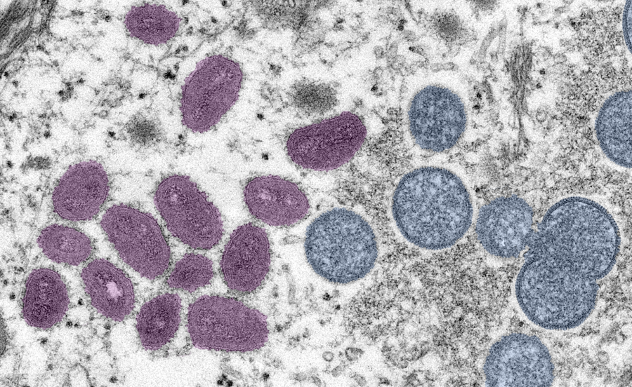 Colorized image of monkeypox