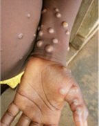 CDC image used to describe monkeypox lesions.